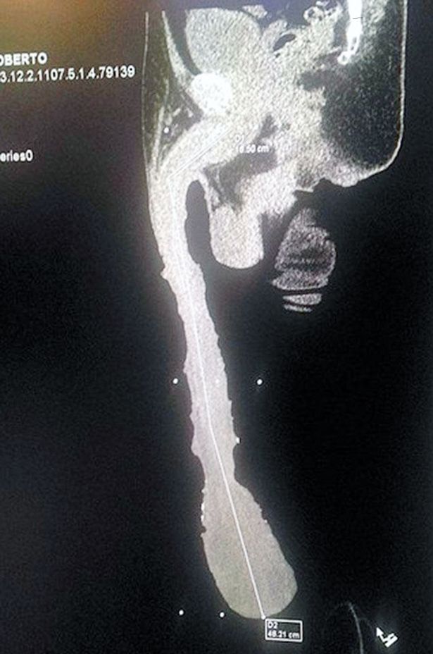 Det hævdede røntgenbillede af Roberto Cabreras penis